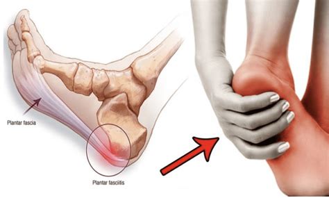 Plantar Fasciitis: Treatment options for your painful heel(s ...