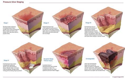 Pressure Sore Ulcer Stages | Bruin Blog