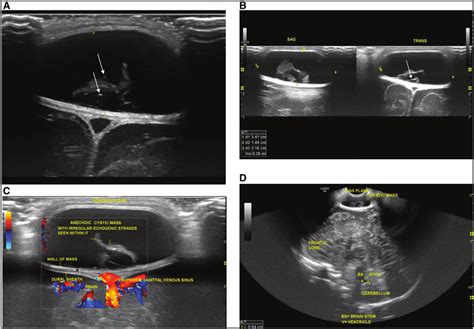 (a) Coronal B-mode ultrasound (US) in the anterior fontanelle shows an ...