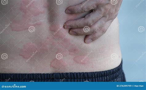 Allergy or Urticaria or Hives or Kaligata on Back Stock Image - Image ...