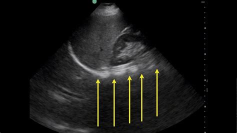 Pleural Effusion On Ultrasound