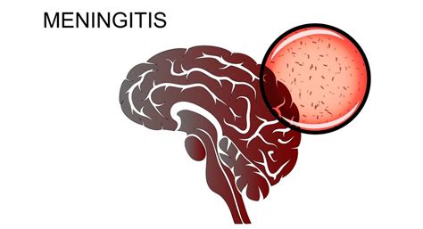 Viral Meningitis; Symptoms, Causes, Diagnosis, and Treatment - Page 5 ...