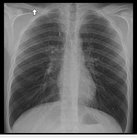 Plain film chest X-ray 12 hours after treatment with 12 liters per ...