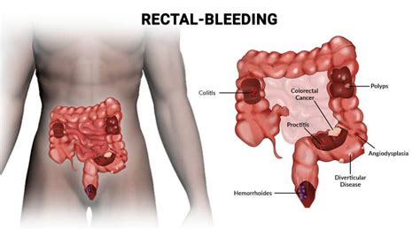 Why Do I Have Bright Red Blood In My Stool? - Manhattan Gastroenterology