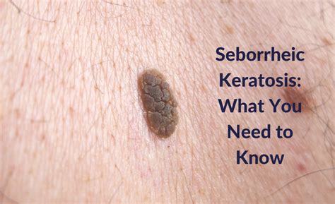 Skin Disorders Seborrheic Keratosis - Infoupdate.org