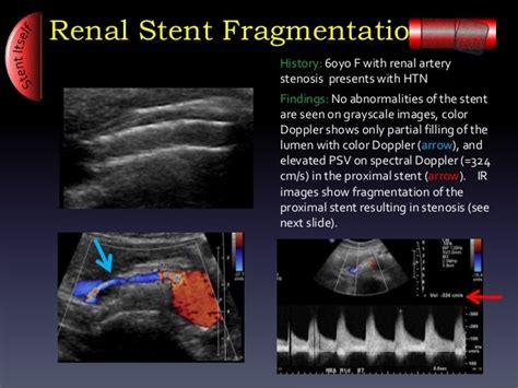 Ultrasound: Arterial Stent Complications by Ali Mian - Yale Universit…