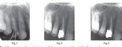 Periapical Abscess Radiograph