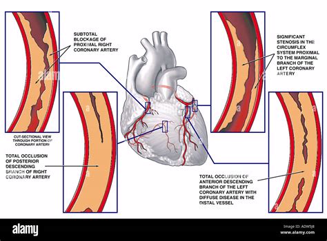 Average Artery Blockage By Age Chart