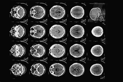 50 years ago, the first CT scan let doctors see inside a living skull ...