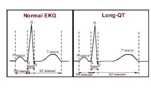 Treatment for Long QT Syndrome (LQTS) in Washington DC & Maryland