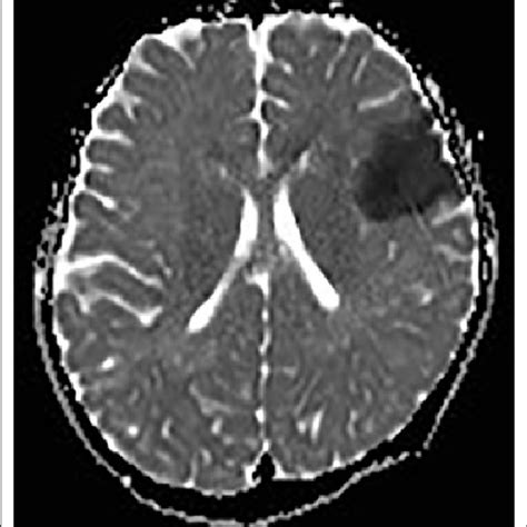 A cerebral MRI scan slice showing a fresh infarction in the left ...