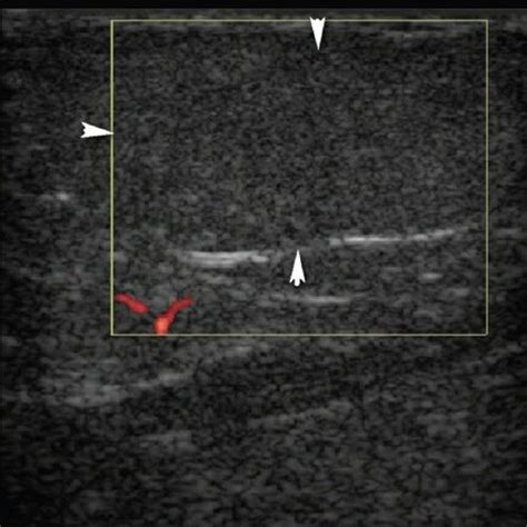 Neck Lipoma Ultrasound Images - Infoupdate.org