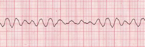 Ventricular fibrillation — Medlibes: Online Medical Library