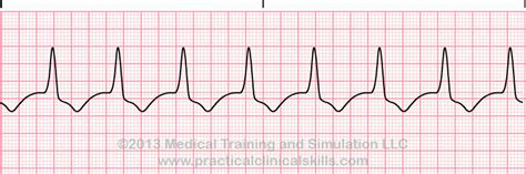 Accelerated Idioventricular Rhythm; AIVR