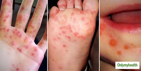 Hand, Foot And Mouth Disease: Symptoms, Causes And Care Tips | OnlyMyHealth