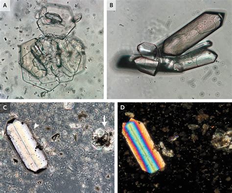 Concomitant Urinary Triple Phosphate and Cystine Crystals | NEJM