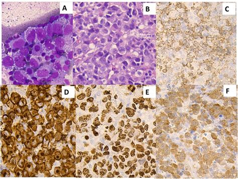 Anaplastic large-cell lymphoma histology numerous large tumor ...