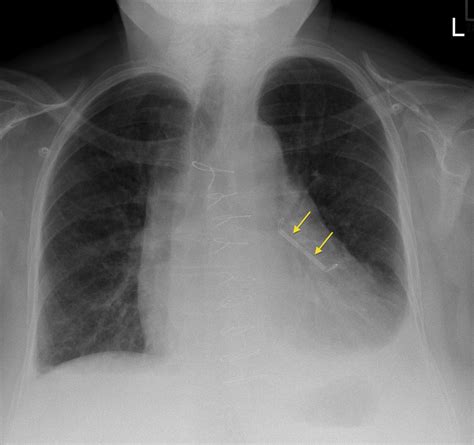 Atrial appendage closure device - Radiology at St. Vincent's University ...