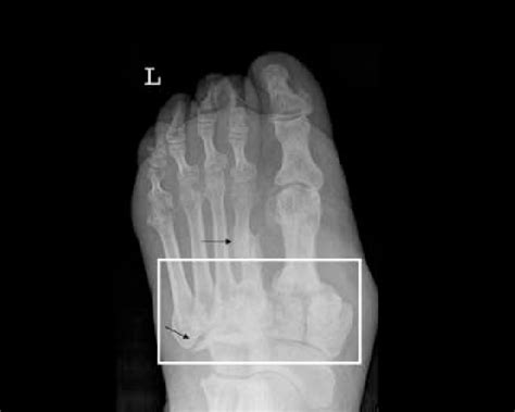 Charcot Joint Radiology - Charcot Joint - Causes, Pathology ...