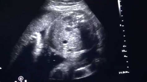 30 WEEKS PREGNANT ULTRASOUND VIDEO - YouTube