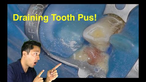 Tooth Abscess Draining Pus!! + Free Endo Gear Guide - Dental Clinic