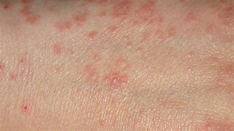 Scabies - Rash, Causes, Signs, Home Remedies, Pictures, Images ...