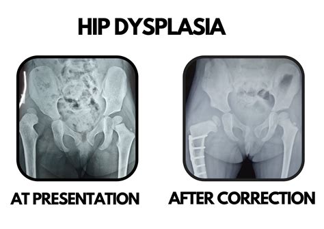 Hip dysplasia & preservation :: Dr Deepak khurana- Paediatric ...