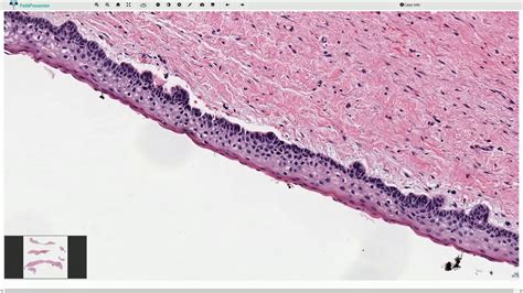 Dentigerous Cyst Histology