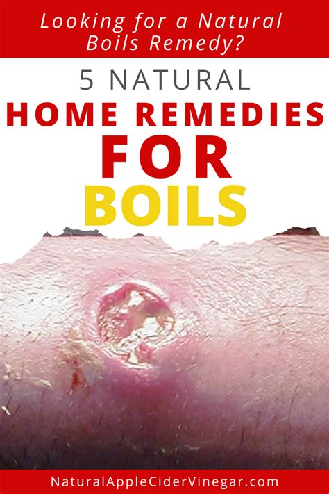 5 Natural Home Remedies for Boils - All Natural Home | Natural home ...