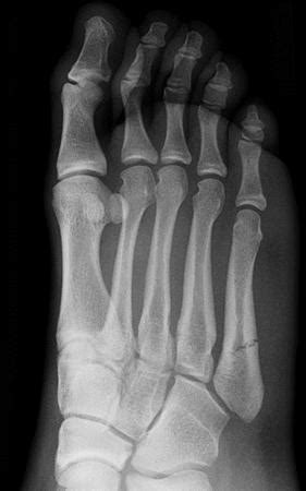 5th Metatarsal Jones Fracture