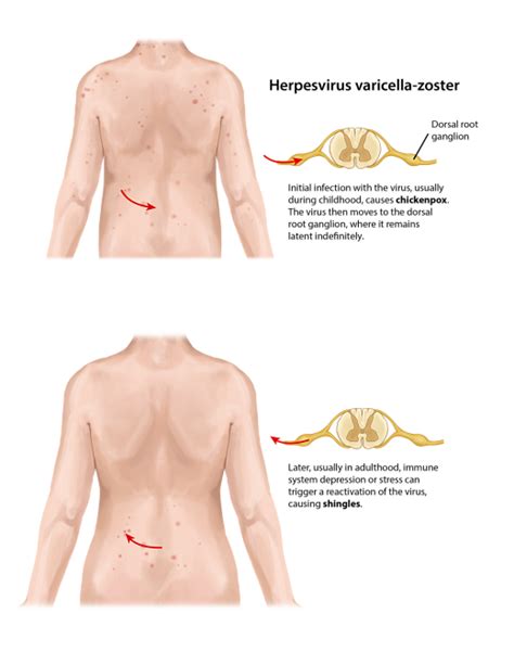 Post Herpetic Neuralgia Treatment | Chronic Shingles Pain | Pain Spa ...