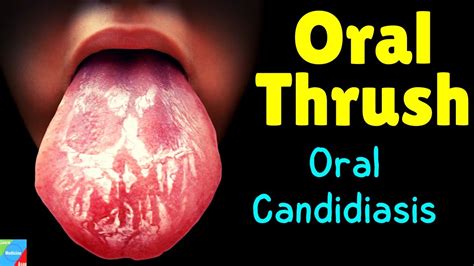 Oral Thrush | Oral Candidiasis – Symptoms, Causes, Diagnosis, Treatment ...