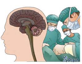 Posterior Fossa Craniotomy for Brain Tumors