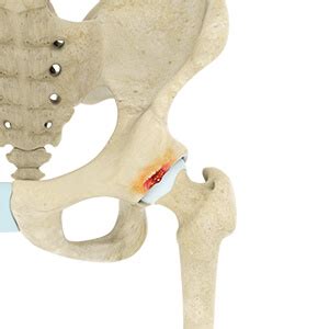 Acetabular Subchondral Cyst Oklahoma City | Hip Trauma Edmond, OK