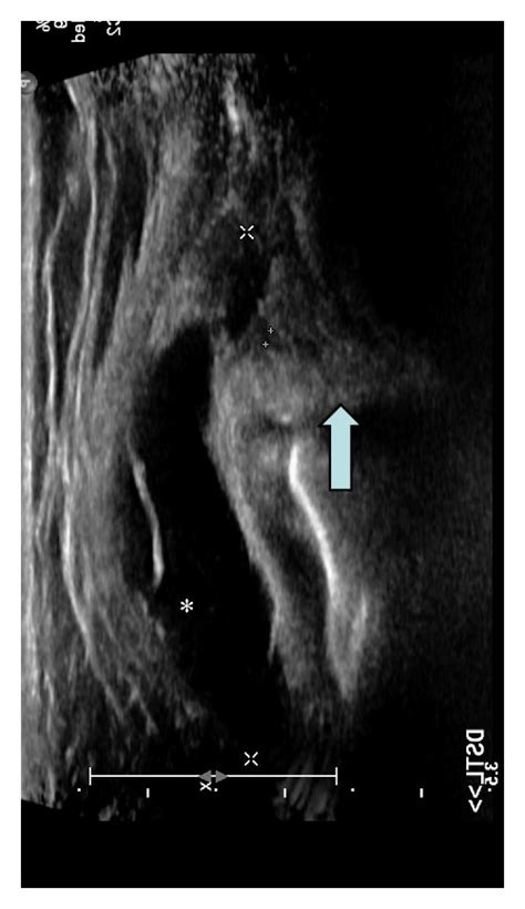 MRI and ultrasound demonstrate the meniscal cyst: (a) coronal ...