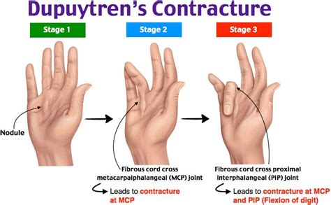 Rosh Review Dupuytren's Contracture, Advanced Nursing, Diabetes, Med ...