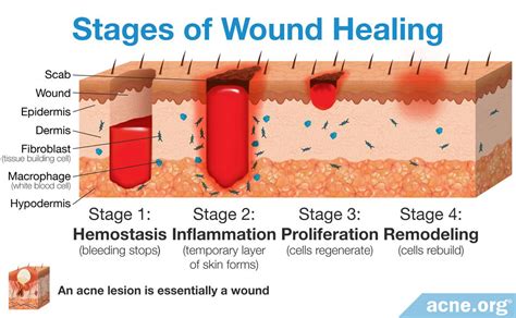 Surgical Wound Healing Stages