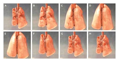 PEEP or No PEEP — Lung Recruitment May Be the Solution | NEJM