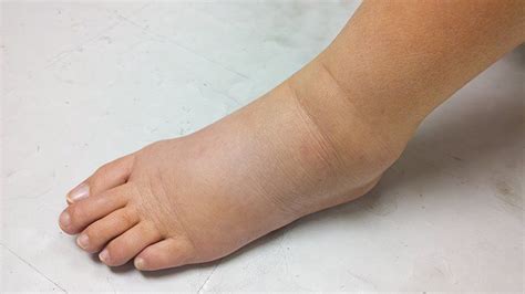 Edema: Symptoms, Causes, Treatments