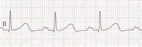 P wave • LITFL • ECG Library Basics