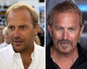 Kevin Costner’s Hair Transplantation from Disaster to Wonder