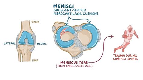 Meniscus tear: Video, Anatomy, Definition & Function | Osmosis