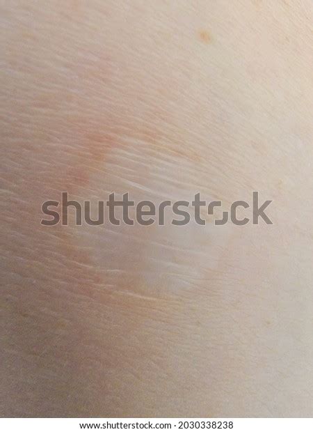 1 Shave Biopsy Scar Images, Stock Photos & Vectors | Shutterstock