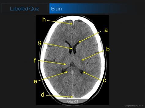 Brain Diagram Labeled Quiz