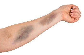 Arm Injury Accidents in Atlanta, Georgia | Rechtman & Spevak