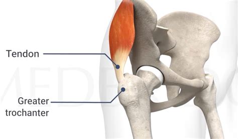 Gluteal tendinopathy and age trends - fpt