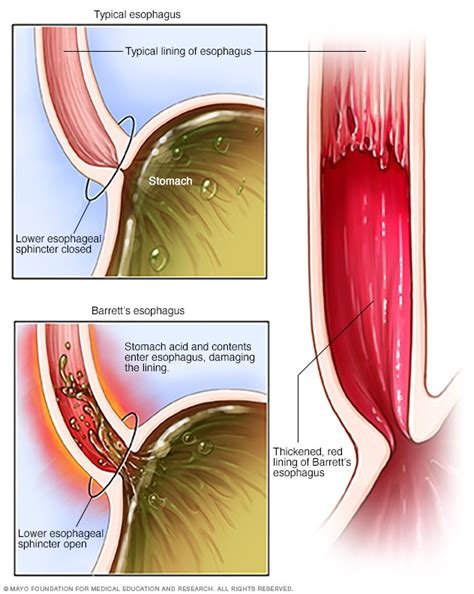 Does Barretts Esophagus Lead To Cancer - CancerWalls