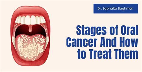 Stages Of Oral Cancer And How To Treat Them | Dr. Saphalta Baghmar