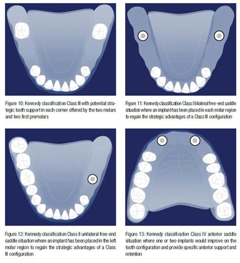 Kennedy Class 1 Rpd Design Mandibular