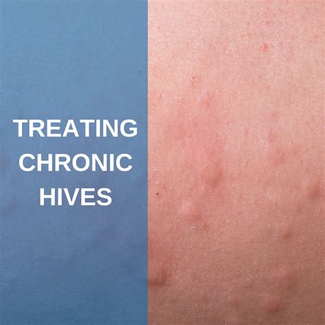 Treating Chronic Hives: What Your Dermatologist Recommends